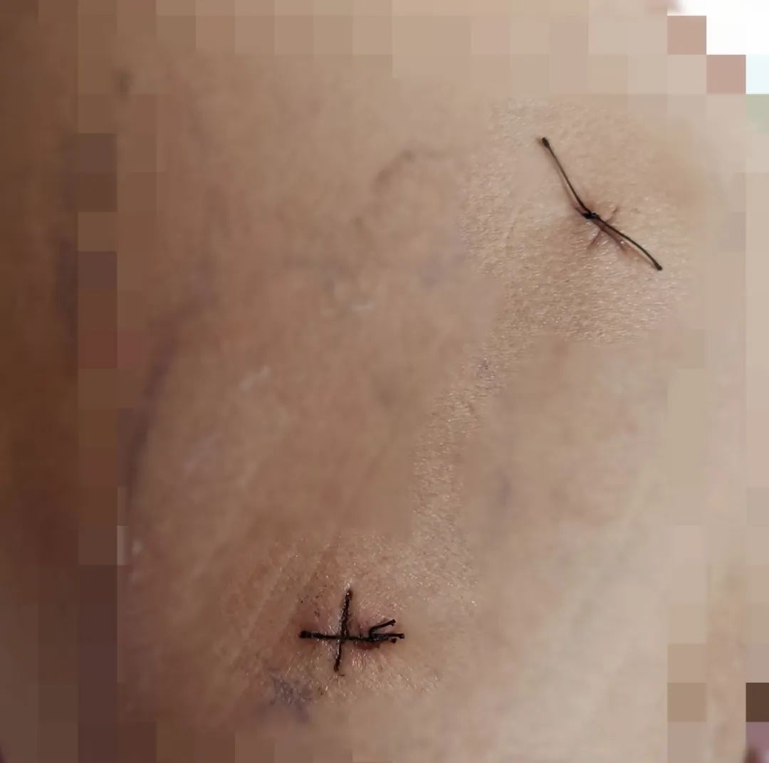 赞｜两个0.5cm小切口助舞蹈女孩儿追梦