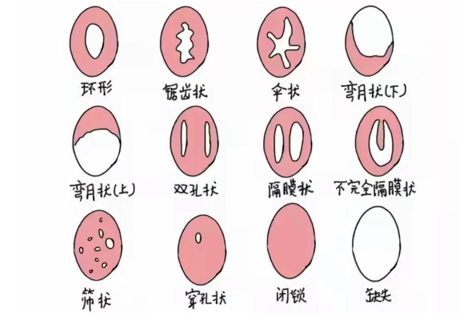 16岁女孩没有月经，到医院检查，被告知没有阴道、子宫，母亲哭了