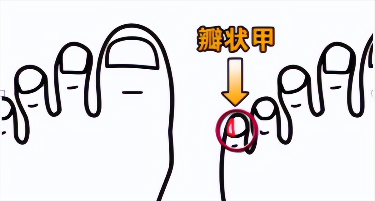 小脚趾甲分成两瓣的人怎么了,小脚趾甲长成两瓣