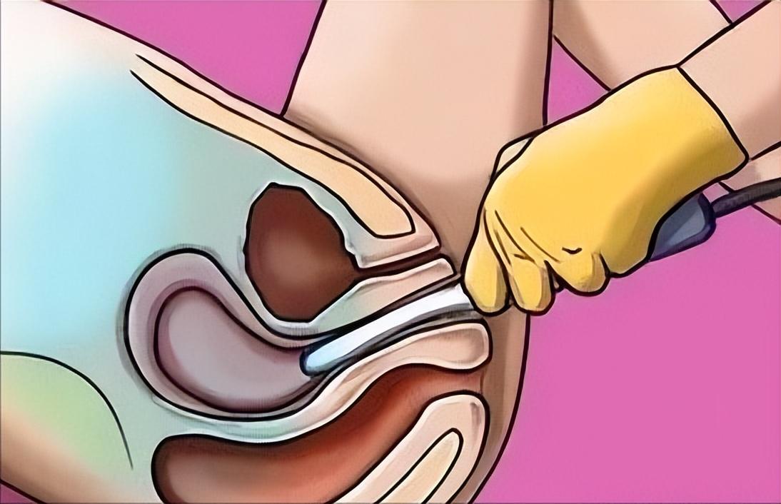 阴式b超都可以检查什么,阴式b超都能检查哪些方面