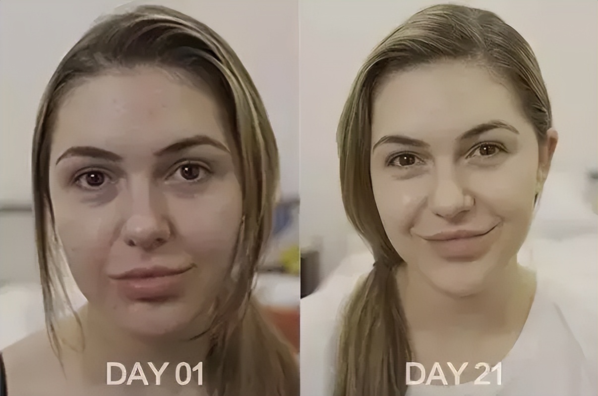 泰国美白针真实事件,女子连续打6年美白针