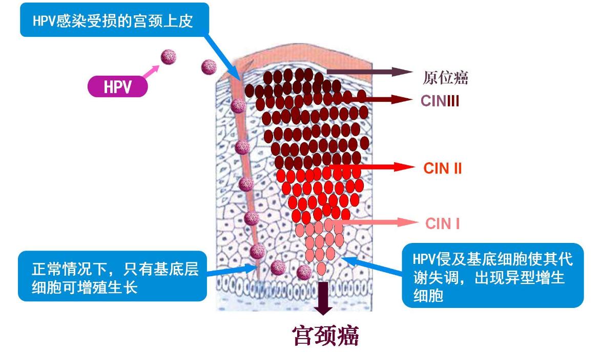 48岁女子确诊宫颈癌，子宫全切，身体这4处异常变化，别再忽视！