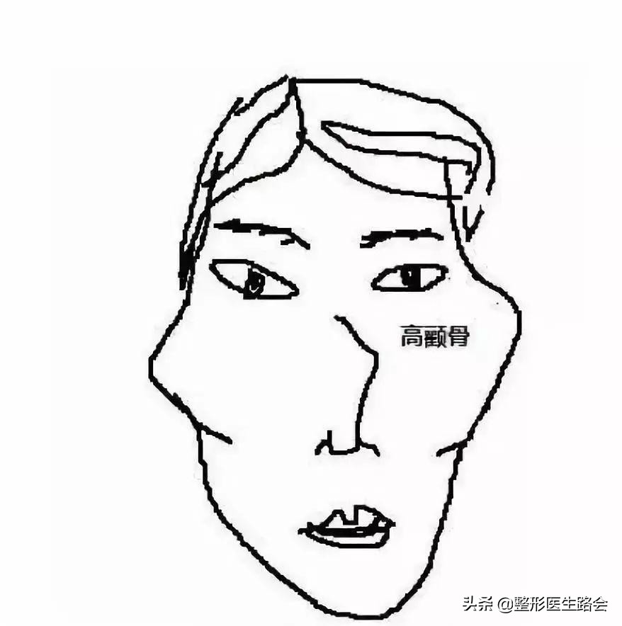 颧骨高太阳穴凹适合什么整形,颧骨高太阳穴凹陷能吃什么改善吗