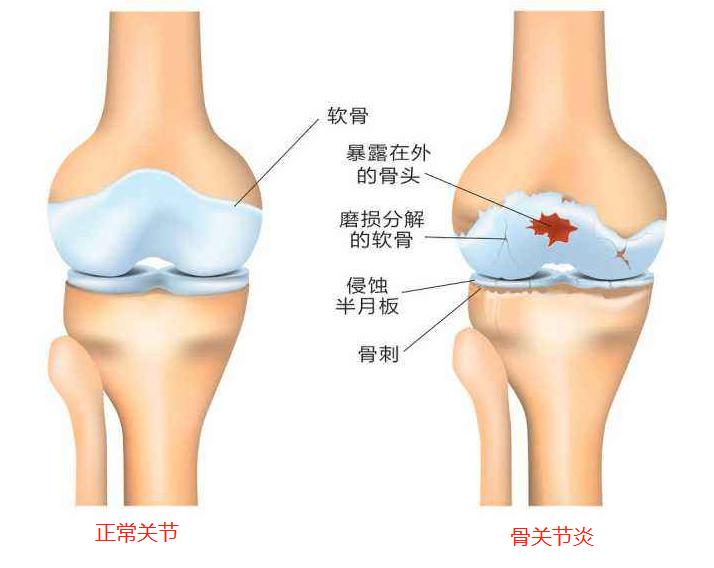 膝关节疼痛是怎么回事怎样治疗,膝关节发软无力疼痛如何缓解