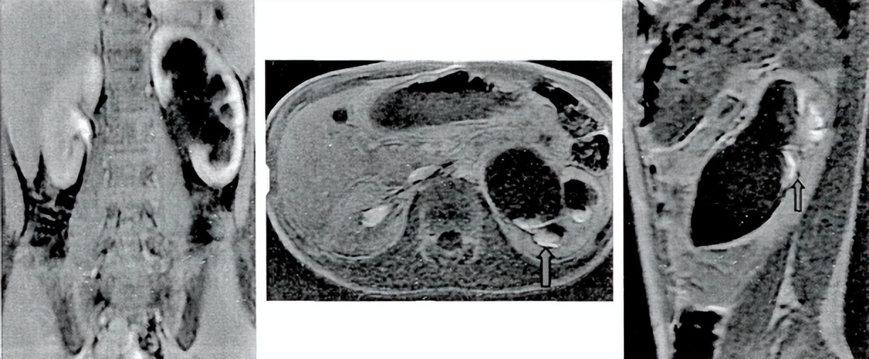 中医治疗宝宝肾积水输尿管狭窄,小儿肾积水和输尿管扩张怎么治疗