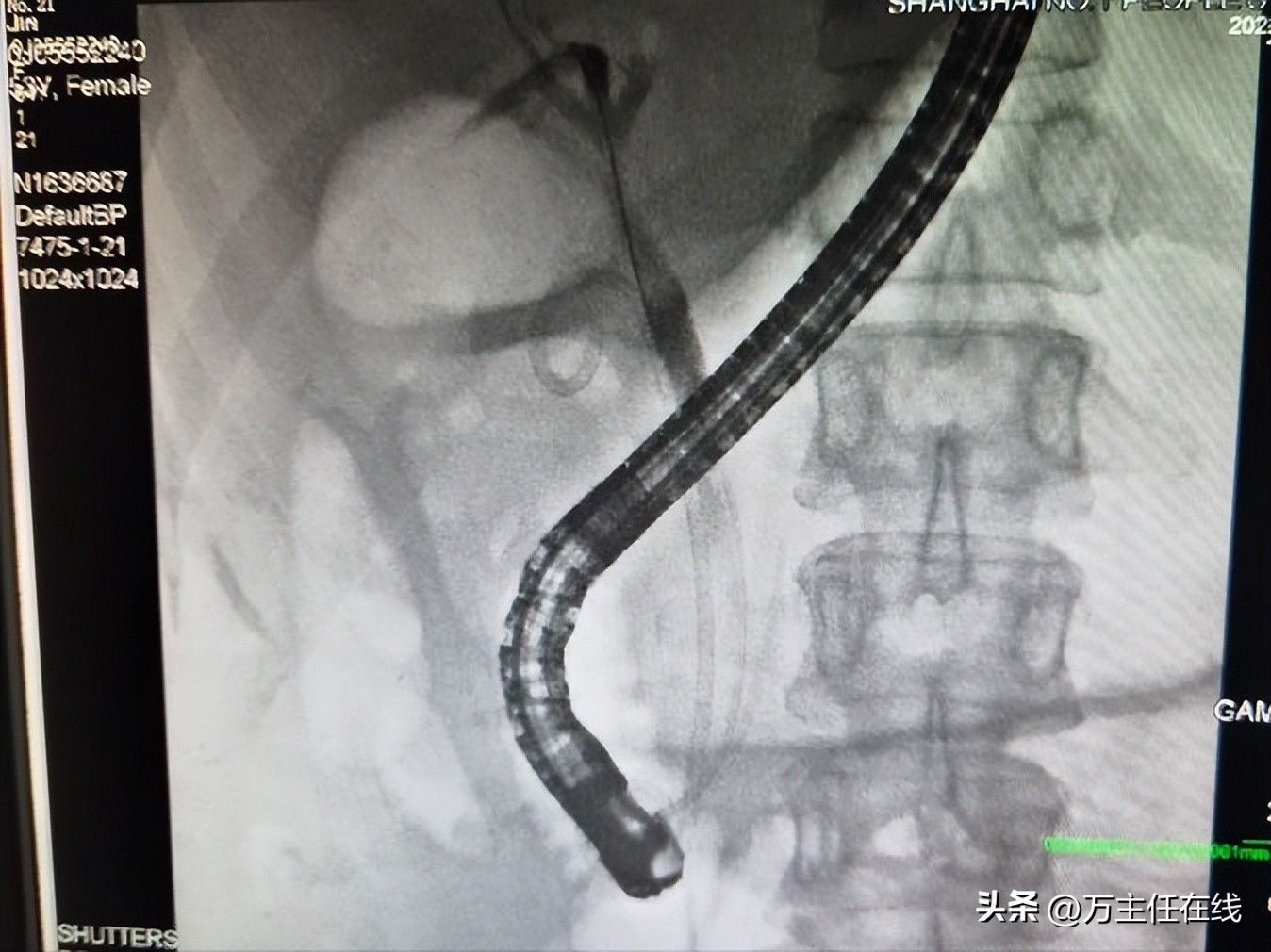 胆结石化脓性胆囊炎,妙手神针巧治疑难杂症