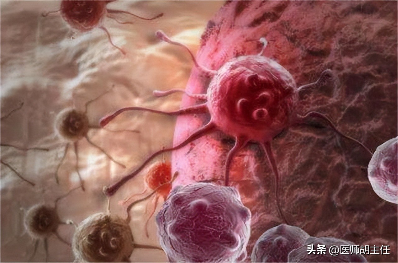 30岁腿痛查出宫颈癌案例,宫颈癌晚期腿上4个信号提示