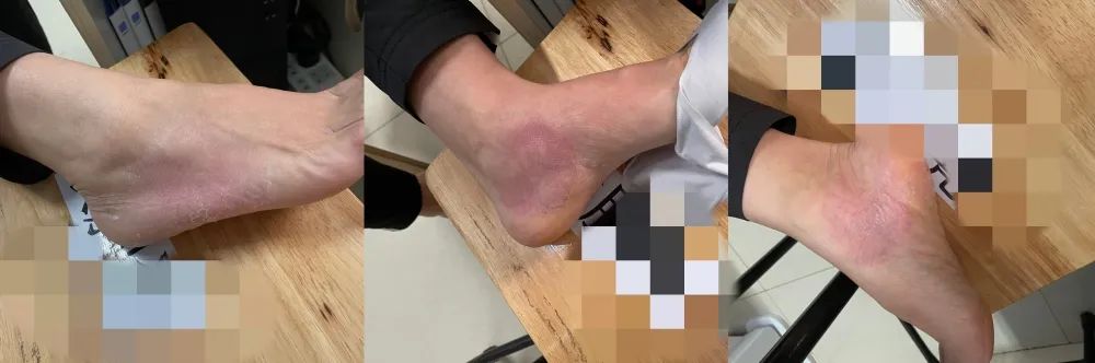 行医笔记：一例掌跖脓疱病的治疗经过