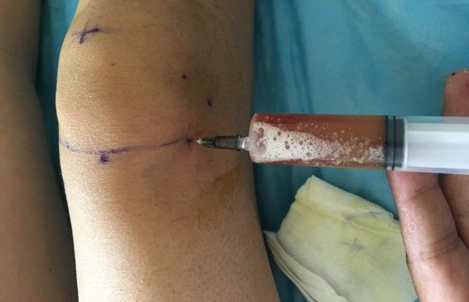 张仲景治疗膝盖冰冷的方子,消水散治疗膝盖积液