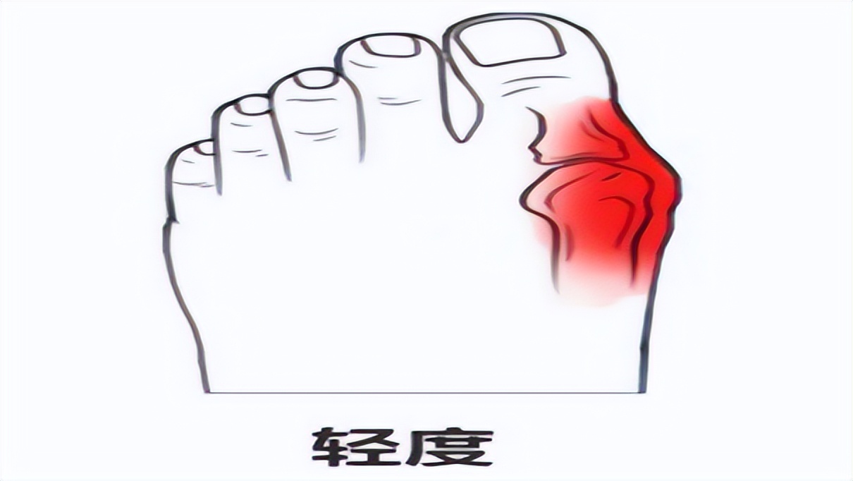 大拇脚趾往里歪怎么矫正,严重拇外翻脚趾畸形怎么办