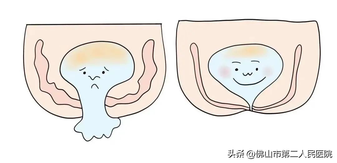 泌尿外科都是“男言之隐”吗？这些病女士也要注意！