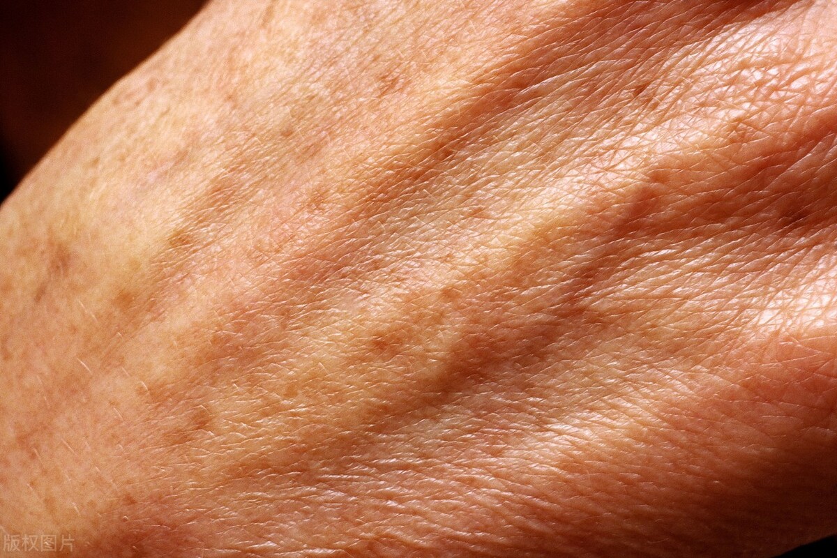 什么样的老年斑会发生癌变,肚子长老年斑是癌症状吗