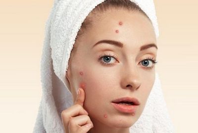 孕期脸上的痘印怎么祛除,脸上的痘印该如何祛除