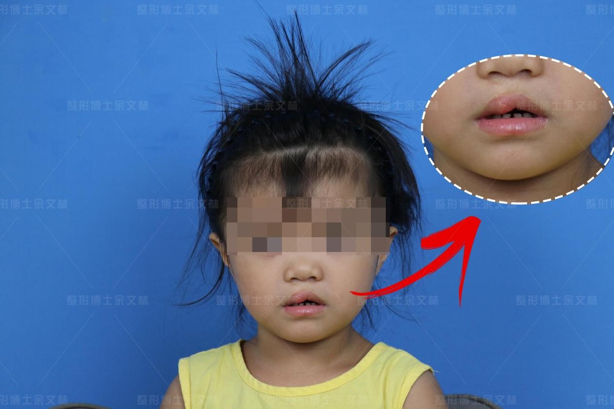 唇裂术后会出现哪些唇部畸形,唇裂造成畸形牙矫正视频