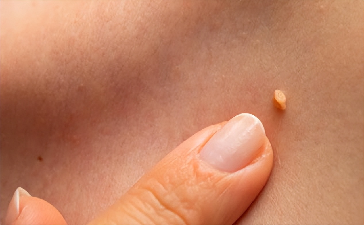 脖子上肉粒可以自己揪掉么,脖子腋下长小肉粒可以用手揪掉吗