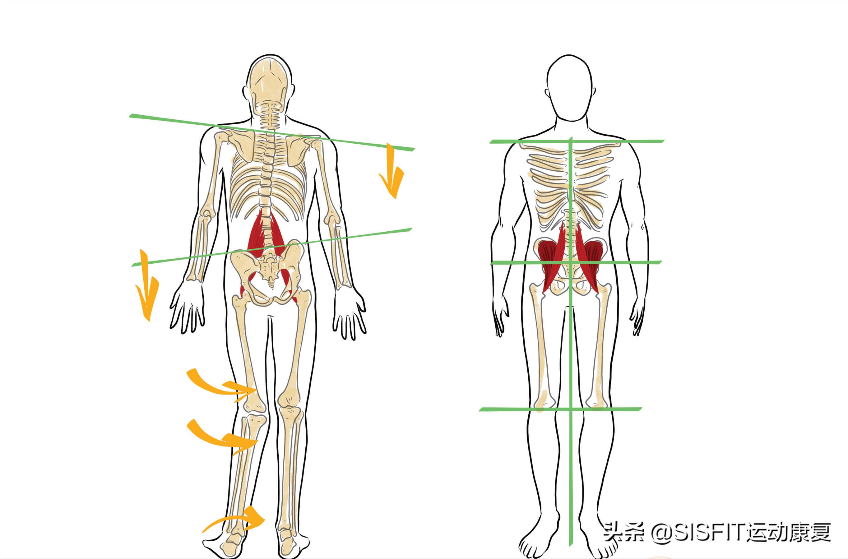 骨盆侧倾的纠正训练,儿童骨盆侧倾纠正