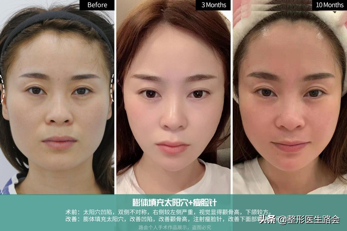 肉毒素和瘦脸针有什么区别图片,肉毒素瘦脸针都有哪些品牌