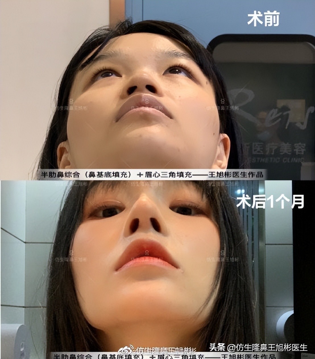 鼻翼缩小可以改善鼻翼缘后缩吗,鼻翼肥大如何正确改善