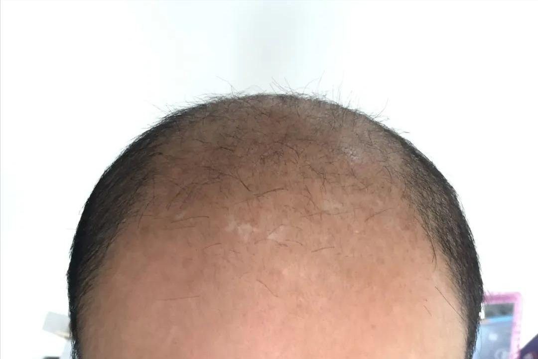 头屑多脱发怎么去除小妙招,头屑如何调理生发最有效