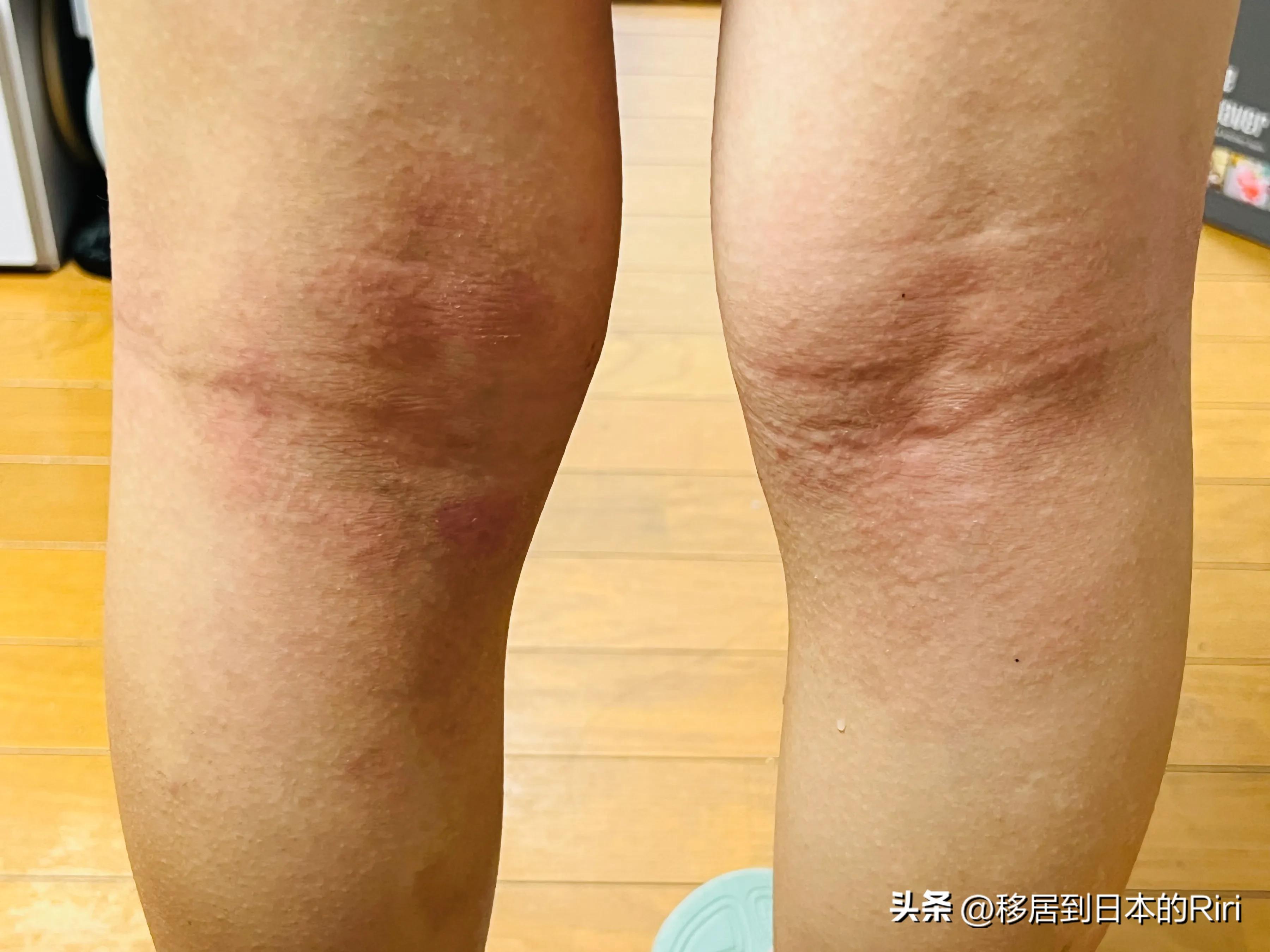 【日本生活】特异性皮炎，半个月跑一次诊所（4）