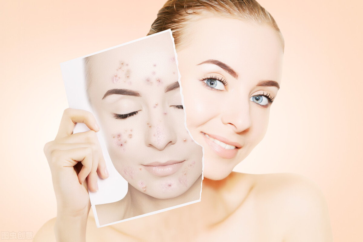 为什么我们脸上会长痘痘,少年脸上长了好多青春痘怎么办