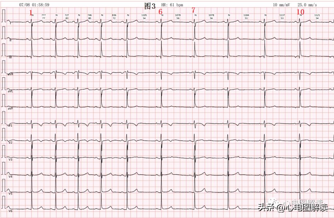 窦房结游走心律的临床意义,窦房结游走心律心电图特征