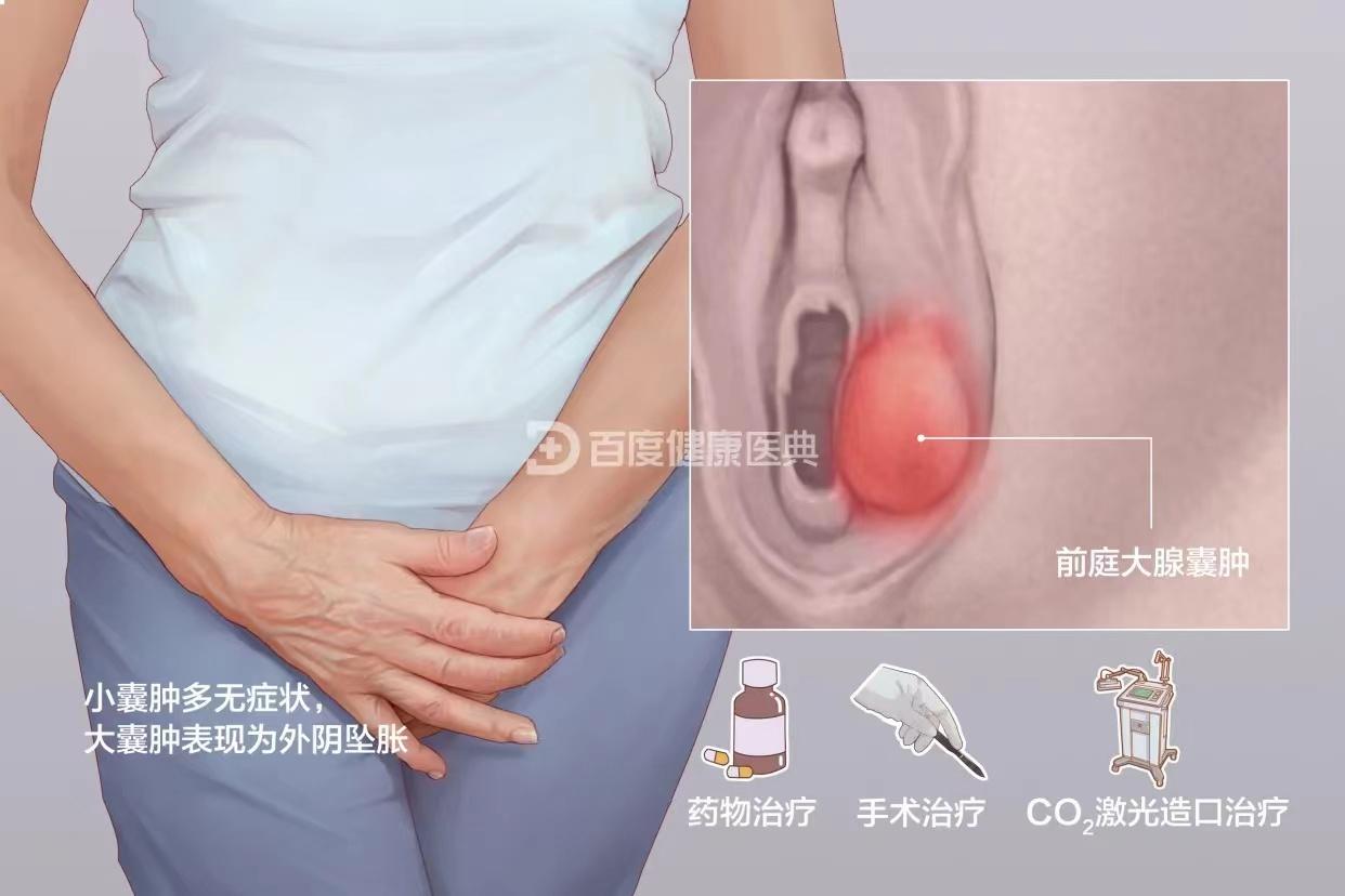 巴氏腺囊肿疼痛怎么治疗最有效,女性巴氏腺囊肿很大不疼能手术么