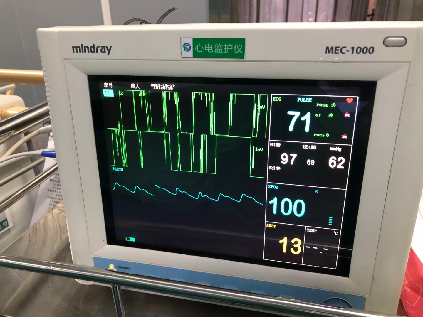 「病例分享」舌癌患者突发大出血，燥动不安，介入治疗成功止血
