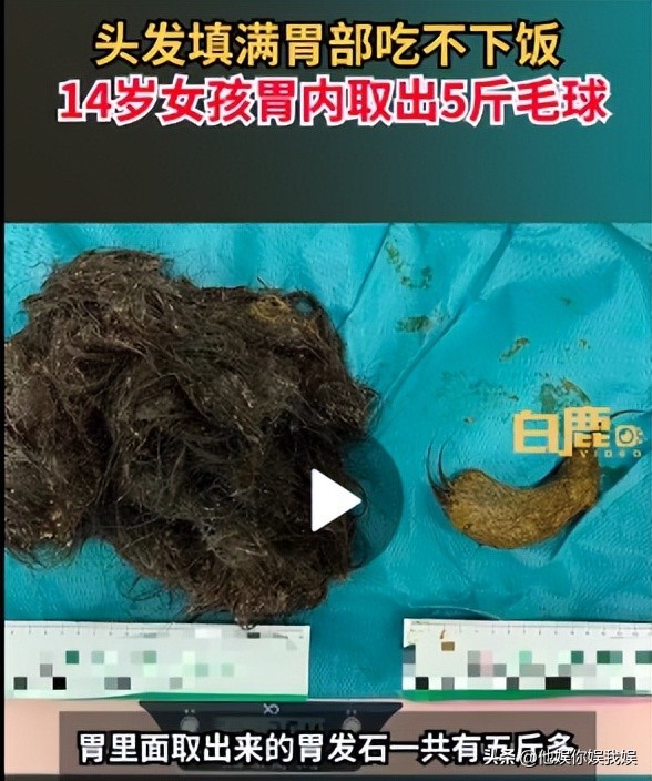 心疼西安这位14岁留守女孩，吃自己头发让胃积满5斤毛球