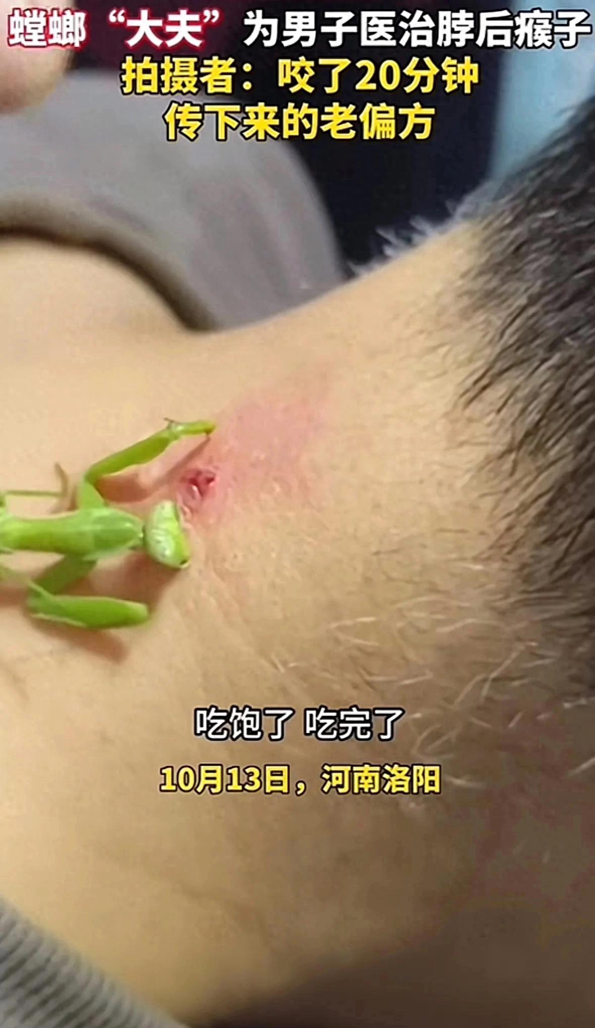 螳螂医治男子脖子后刺瘊,老中医用螳螂治疗脖子上的瘊子