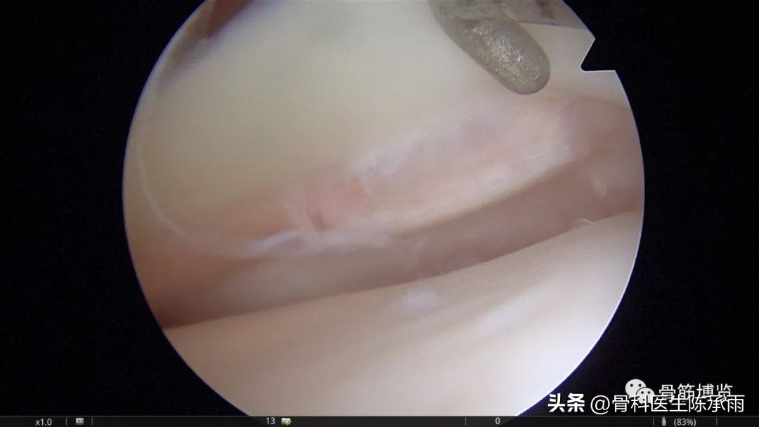 1-2度半月板后角损伤,半月板后角损伤手术解决方案