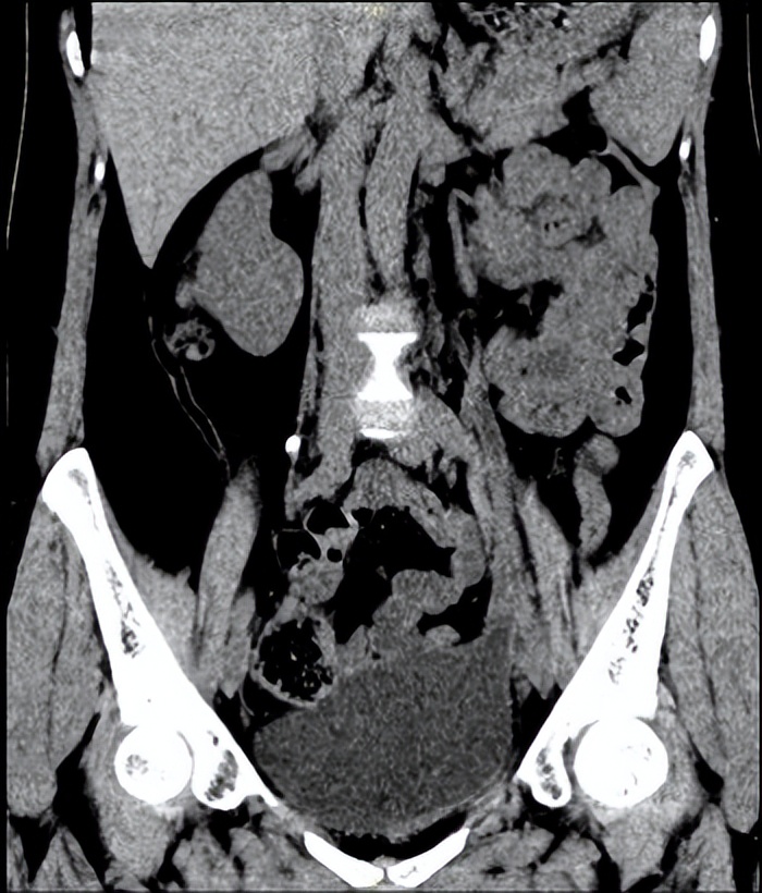 达芬奇系列|哈医大一院泌尿外科王春阳机器人团队巧用膀胱肌瓣重建输尿管助女性解除阴道漏尿困扰