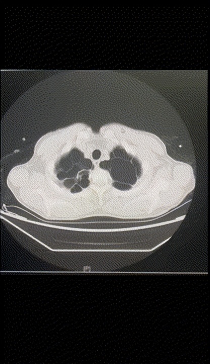 协和医院治疗主动脉夹层的成功率,协和主动脉夹层