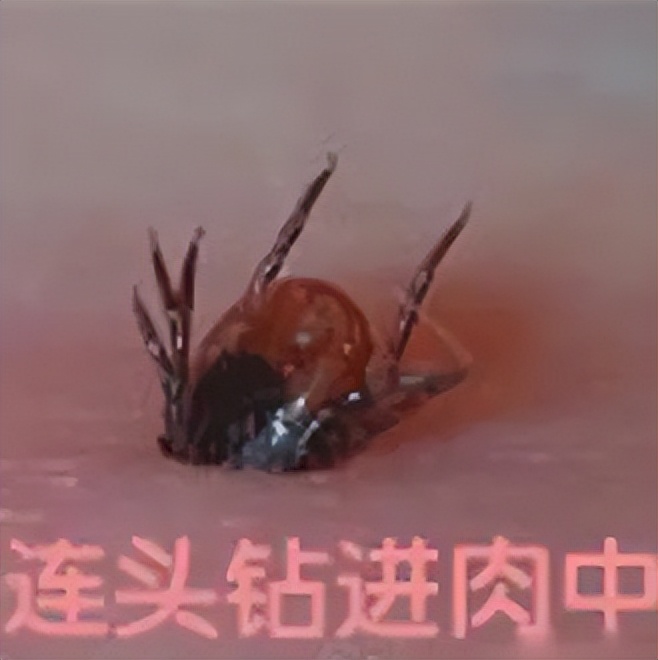 虫子的小刺扎进皮肤里怎么办,钻进皮肤的虫子