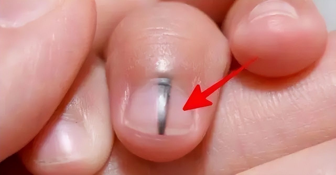 指甲出现斑块都是癌吗,指甲上有征兆或是甲状腺出了问题