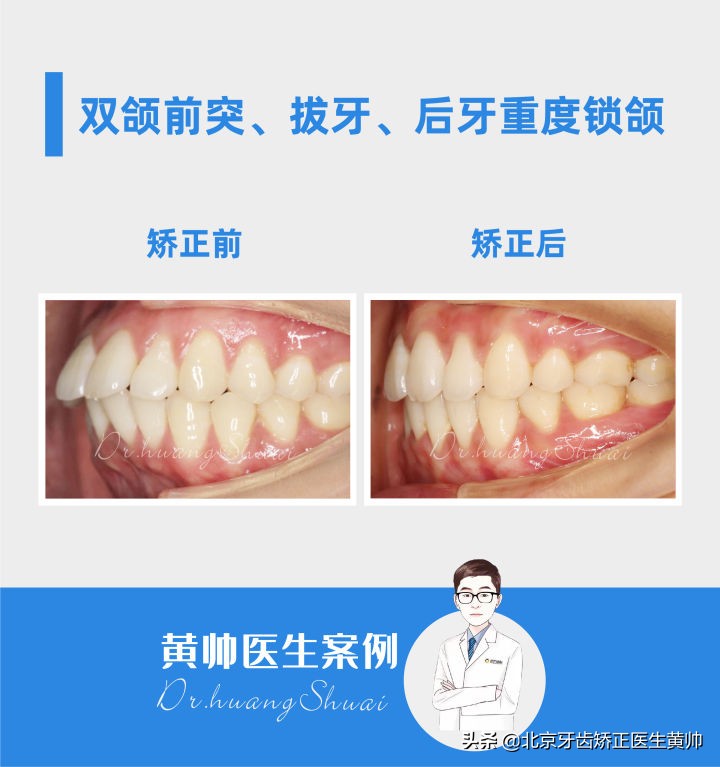 嘴凸的人怎么笑起来好看,嘴凸怎么让自己不焦虑