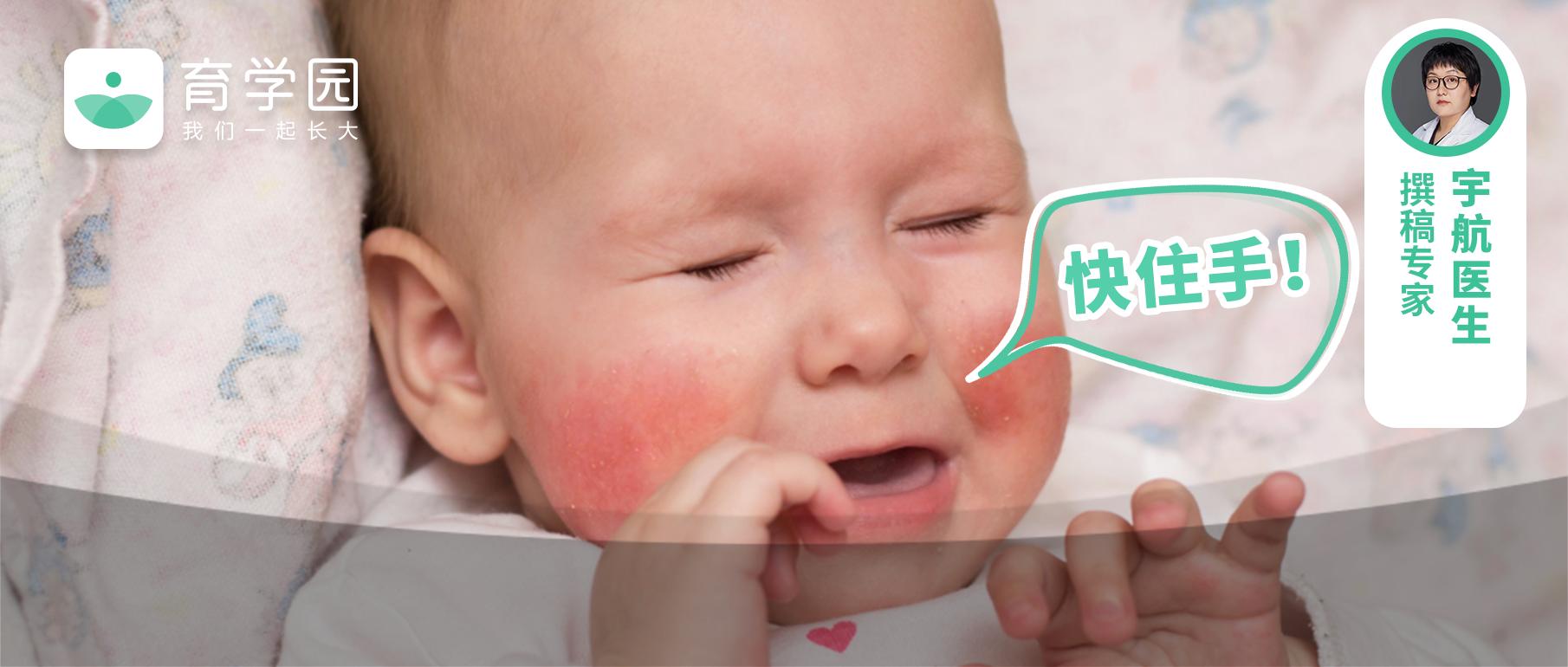 脸上起疹子擦宝宝霜,最近曝光的宝宝霜