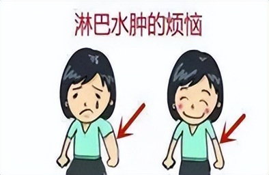 乳腺癌术后淋巴水肿的中医外治,乳腺癌术后游泳会引起淋巴水肿吗