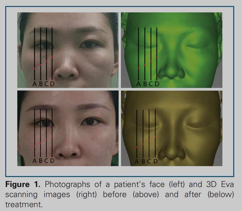 印第安纹解剖学,印第安纹分型对策