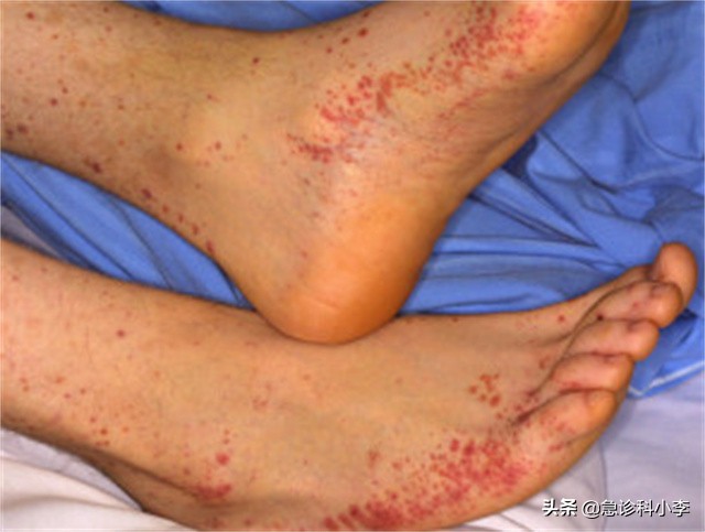 身上出现不痒的小红点是怎么回事,身上突然起了很多小红点不痛不痒
