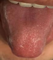 手脚心热吃六味地黄丸咋不见效呢,手脚心发热口干吃知柏地黄丸好吗