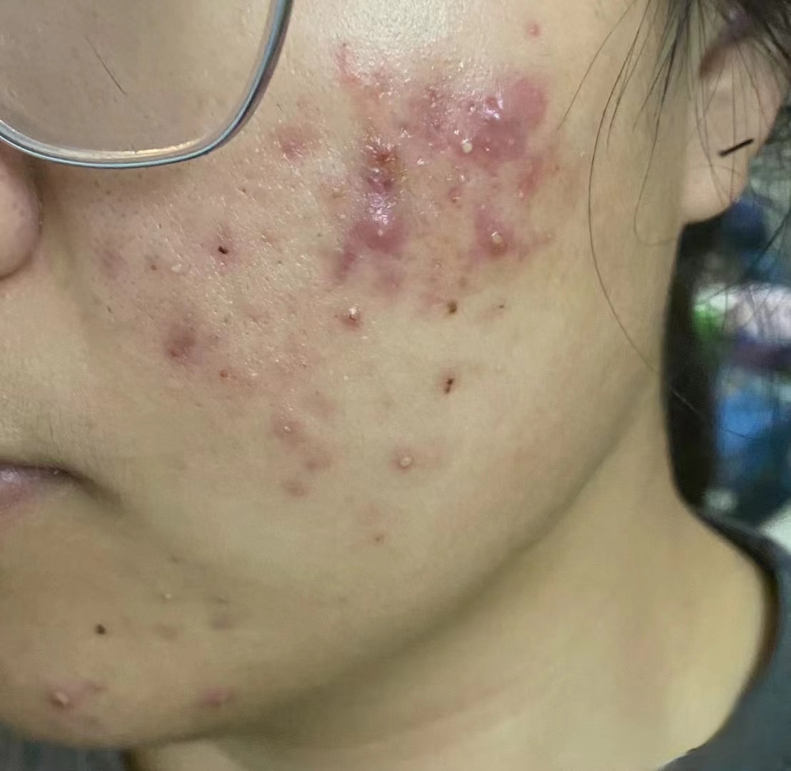 除疮小妙方,治毒疮最快的偏方