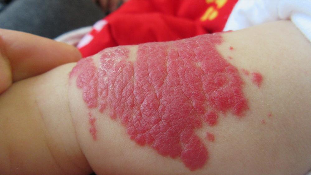 小孩身上的红痣可能是血管瘤,幼儿身上小红点富贵痣竟是血管瘤