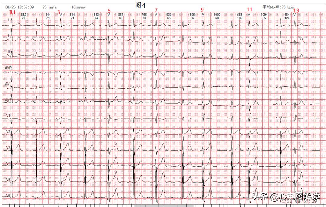 可见室性融合波是什么意思,室性融合波什么意思