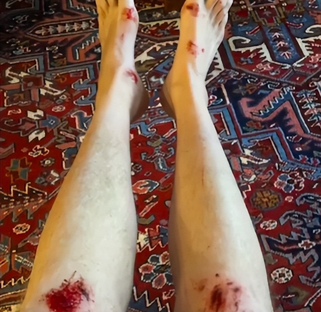 注意！BC华人爱买食品含致命菌被召回！恶搞挑战:女子险残疾！