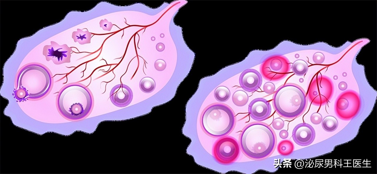 大部分女性都会长子宫肌瘤吗,如何防止长子宫肌瘤