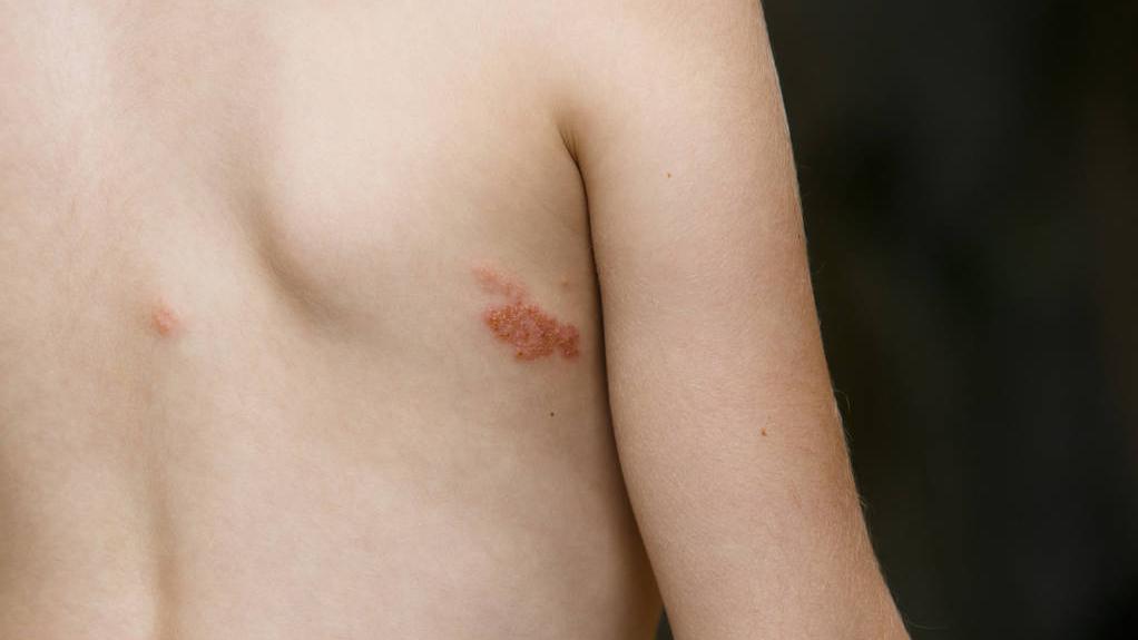 水痘单纯带状疱疹,单纯疱疹病毒与水痘带状疱疹病毒