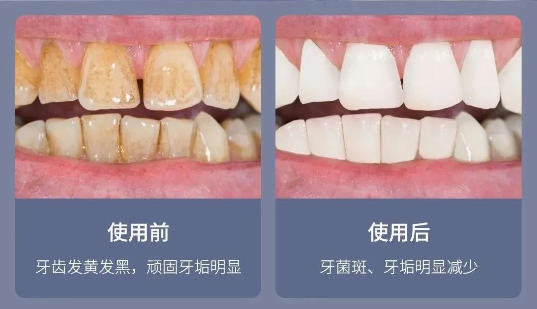 电动冲牙器便携式深层清洁牙齿,牙刷电动软毛护牙