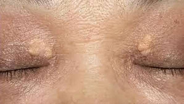 眼周起红色的小疙瘩是怎么回事,眼周起的小疙瘩别忽视