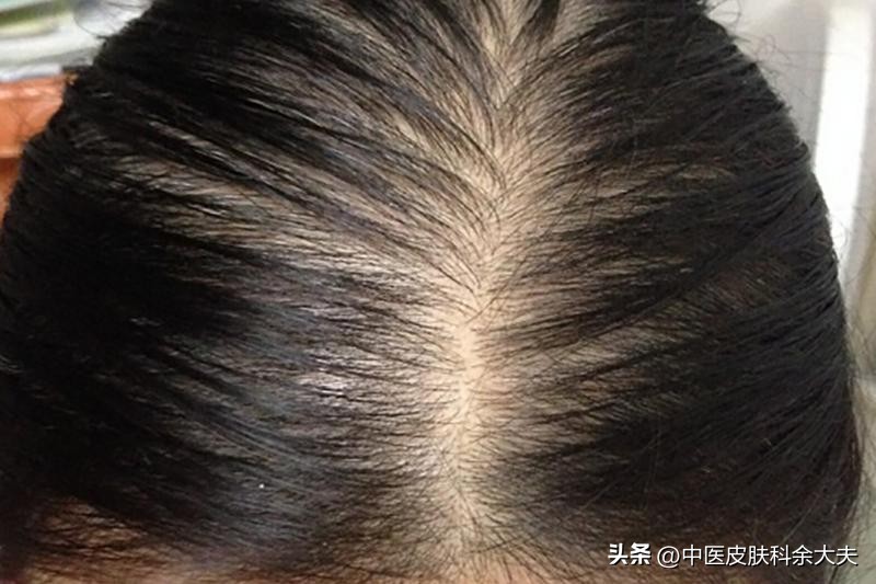 脱发是气血不好的表现吗,脱发说是内分泌失调什么意思